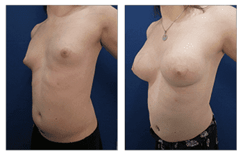 A woman's breast before and after Breast Augmentation surgery.