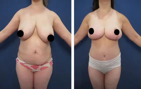 Creating the Best Belly Button for a Tummy Tuck