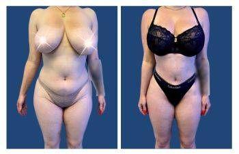 What Causes the Pulling Feeling After A Tummy Tuck?