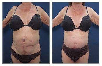 Tummy Tuck — #SS278