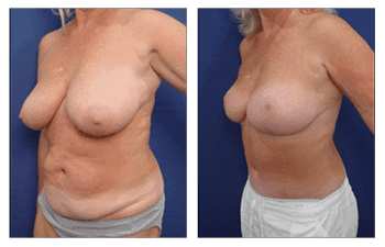 orange county mommy makeover patient patient 23 front left