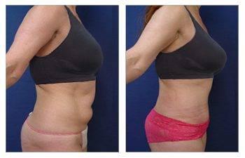 Tummy Tuck Alternatives