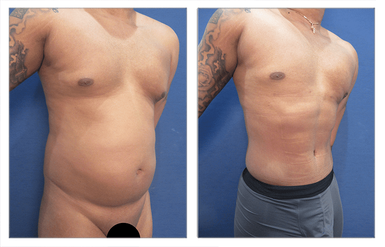 Tummy Tuck Belly Button