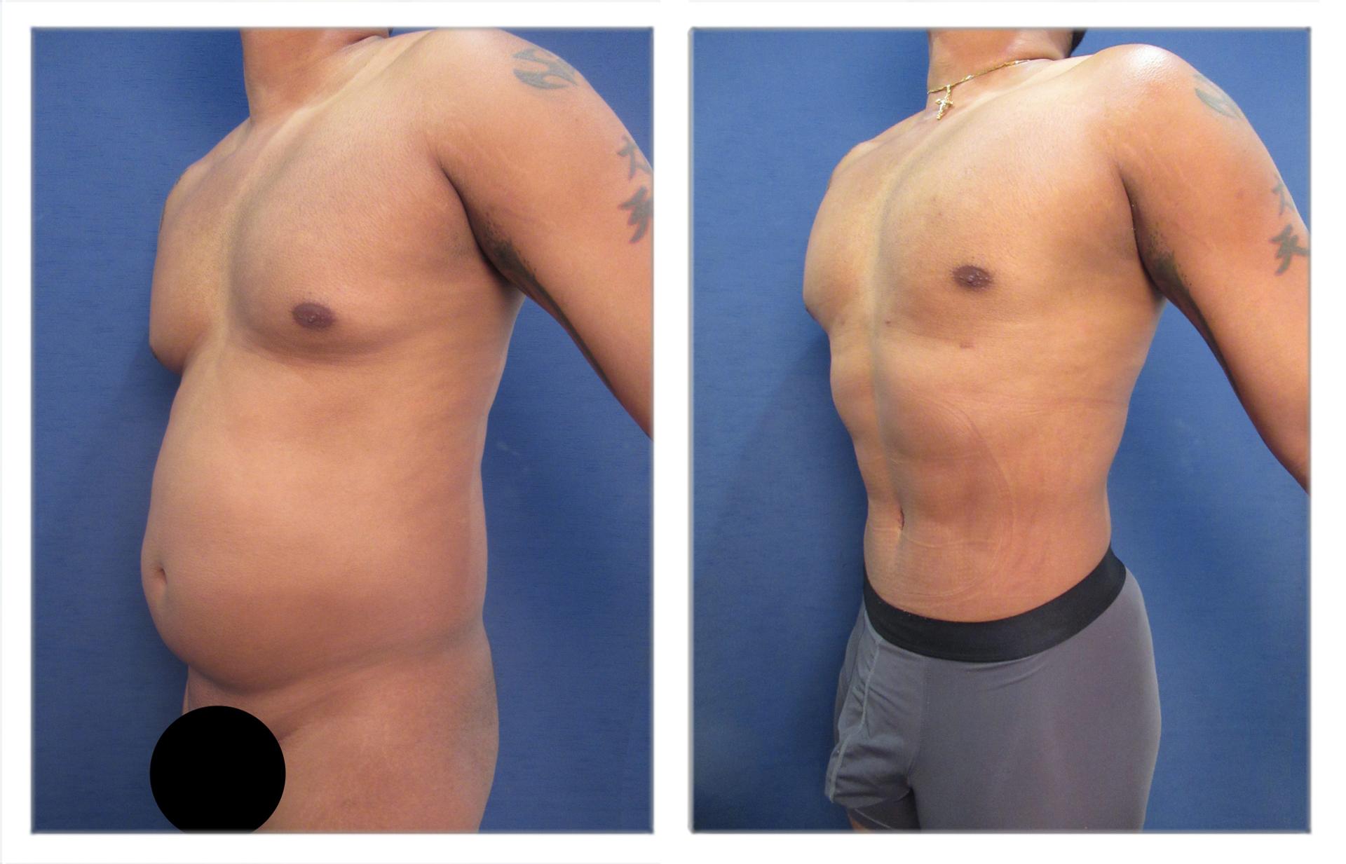 Tummy Tuck Belly Button