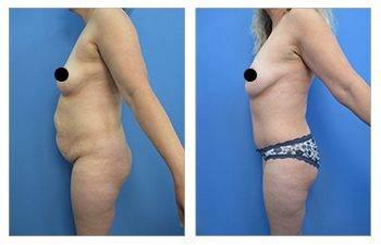 Staged body contouring with tummy tuck before and after transformations.