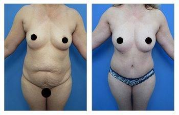 Tummy tuck for plus sized clients — patient photo