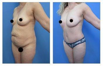 A woman's breast before and after surgery for breast augmentation.