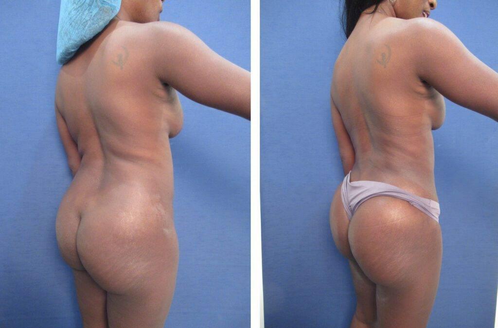 VASER Lipo vs. Smart Lipo — photo 2 | SurgiSculpt®
