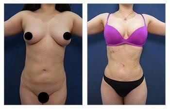 Vaser Liposuction Cost