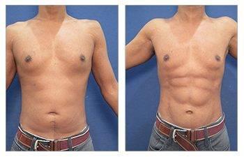 Tummy tuck before and after with vaser lipo in the UK.