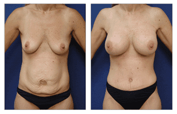 Tummy Tuck