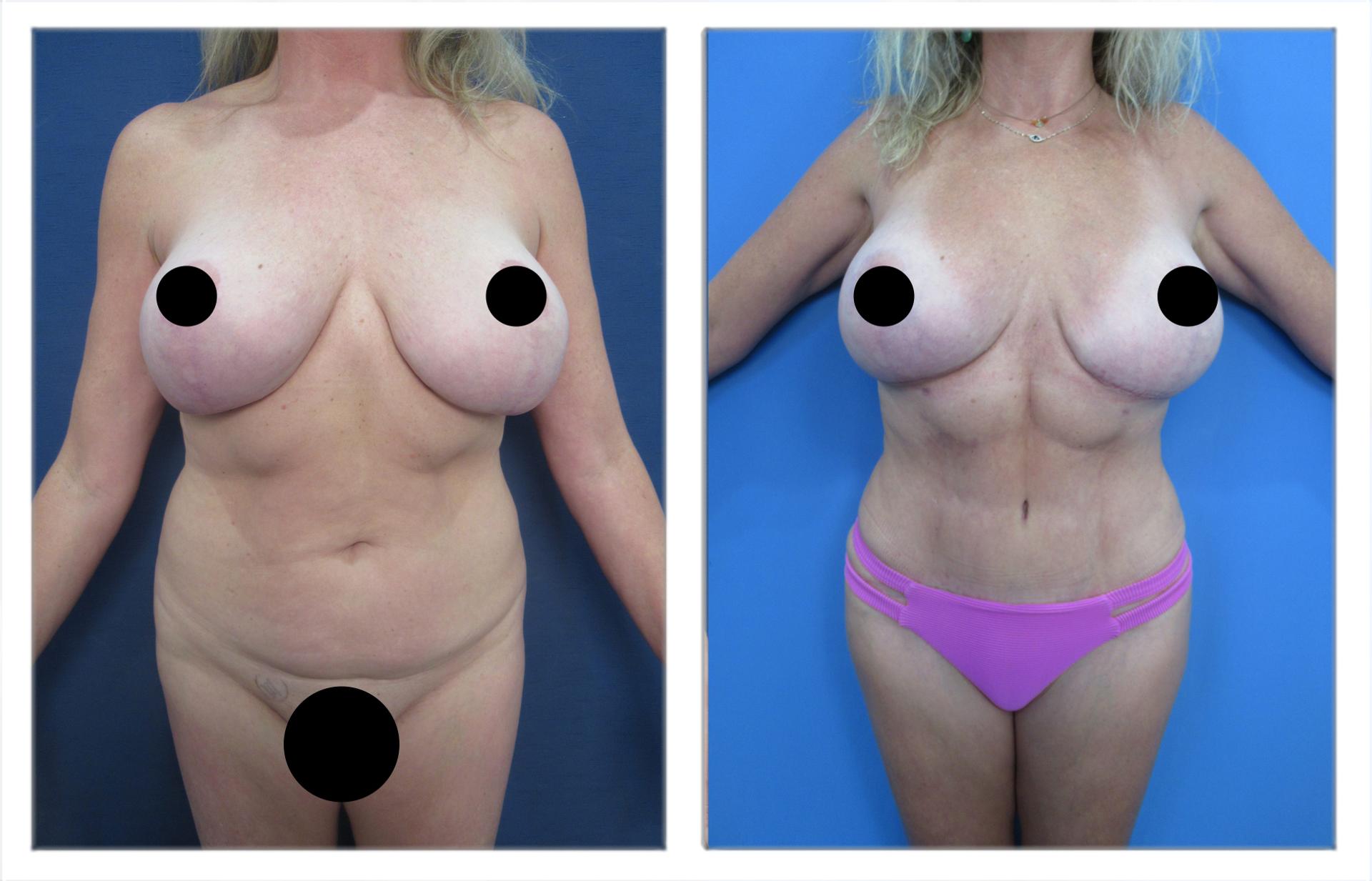 Ex-vivo liposuction
