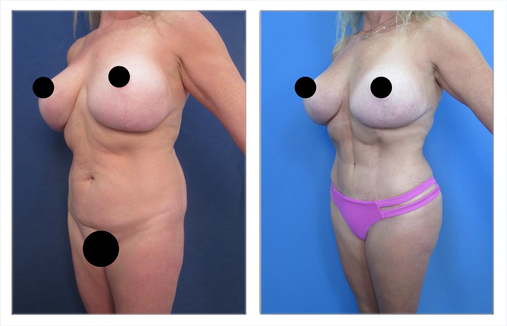 Ex-vivo liposuction