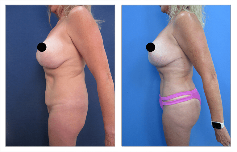 What does ex-vivo liposuction mean for a Plus-sized Client