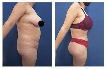 What is A Body Lift?
