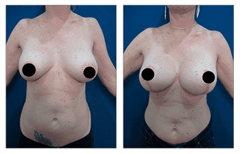 What is a Breast Lift with Implants Over the Muscle?
