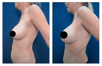 What is a Breast Lift with Implants Over the Muscle?