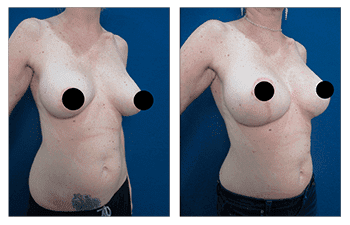 What is a Breast Lift with Implants Over the Muscle?