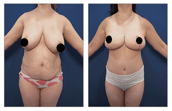 A woman's breasts before and after a breast lift with Breast Augmentation.
