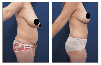Tummy tuck and liposuction before and after.