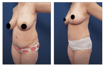 A woman's breast before and after Breast Augmentation surgery.