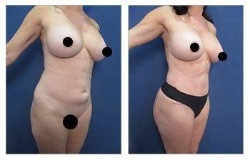 What is Carboxypneumodissection? — patient photo