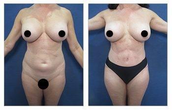 What is Carboxypneumodissection? — patient photo