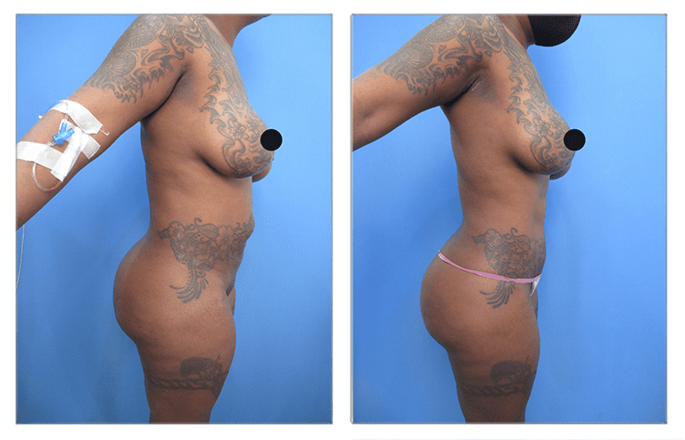ex-vivo liposuction