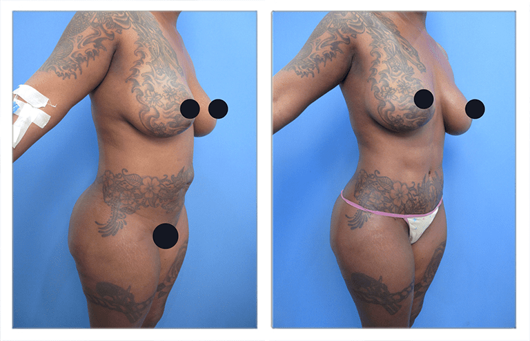 ex-vivo liposuction