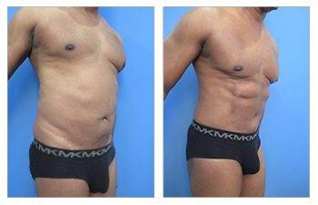 high definition liposuction