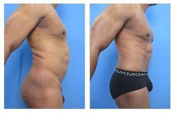 high definition liposuction