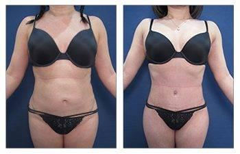 Safe Liposuction