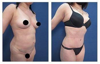 What is Safe Liposuction?