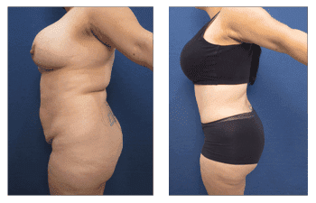 What Is The Cause Of Lipedema?