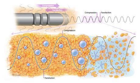 A diagram showing the structure of an atom and how it interacts with other atoms during VASER Liposuction.