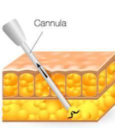 A diagram of a canula with a needle in it, used in VASER Liposuction.