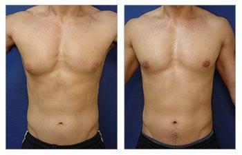 A woman's breast before and after Mommy Makeover surgery, addressing upper belly fullness.