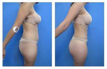 Who Does the Most VASER Liposuction Surgeries