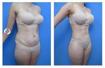 Who Does the Most VASER Liposuction Surgeries
