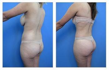 Who Does the Most VASER Liposuction Surgeries