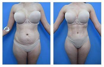 Who Does the Most VASER Liposuction Surgeries
