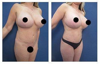 Why is VASER liposuction ideal for Brazilian Buttock Lift — patient photo