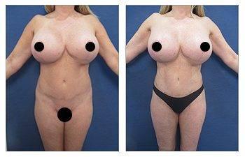 Why is VASER liposuction ideal for Brazilian Buttock Lift