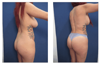 Hd Body Contouring