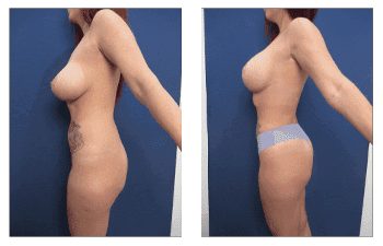 Hd Body Contouring