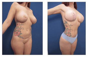 Hd Body Contouring