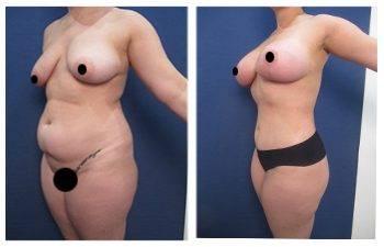 A woman's breast before and after surgery, focusing on the transformation post-surgery.