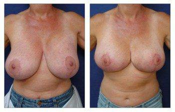 Breast Augmentation Revision — #SS216