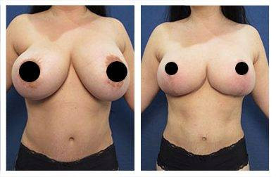 Breast Lift — #SS326