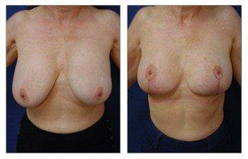 Breast Augmentation Revision — #SS230